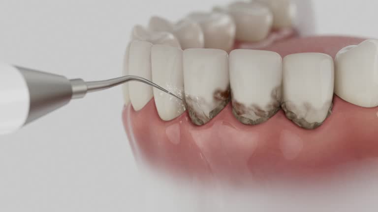 Reliable Wisdom Tooth Removal contractor in Midvale, UT by Smile Center Dentistry